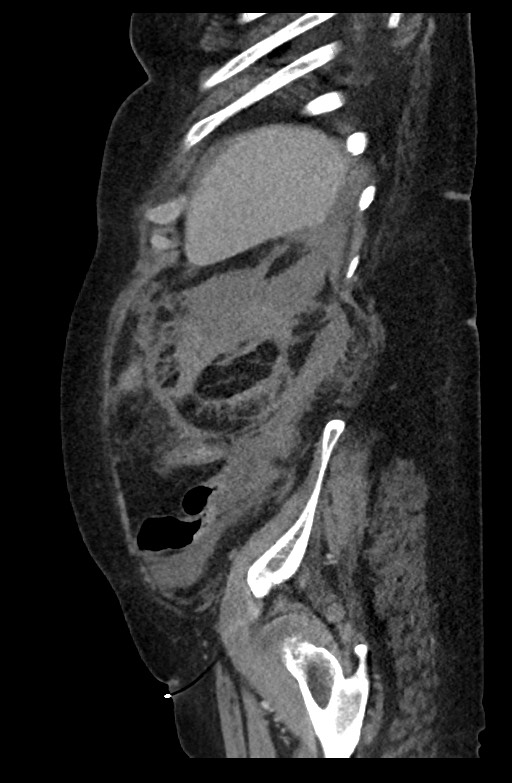 Active renal extravasation with large subcapsular and retroperitoneal hemorrhage (Radiopaedia 60975-68796 Sagittal C+ portal venous phase 60).jpg