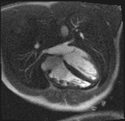 Active right ventricular cardiac sarcoidosis (Radiopaedia 55596-62100 Axial Dynamic perfusion scan MOCO 63).jpg
