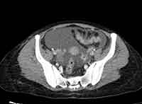Acute Budd-Chiari syndrome (Radiopaedia 60858-68638 A 242).jpg