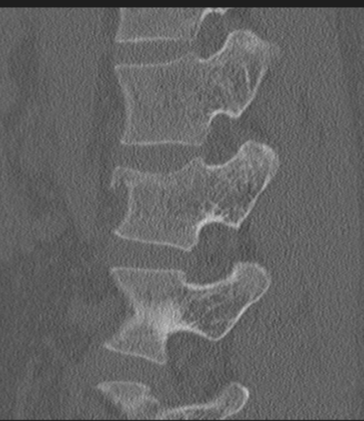 Acute L1 burst compression fracture (Radiopaedia 34430-35755 Sagittal bone window 22).png