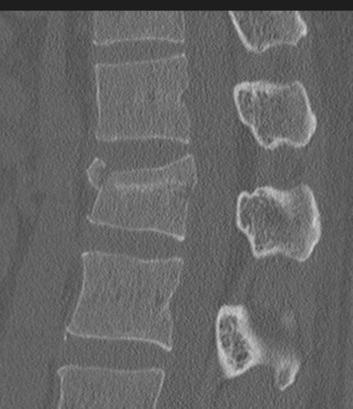 Acute L1 burst compression fracture (Radiopaedia 34430-35755 Sagittal bone window 33).png