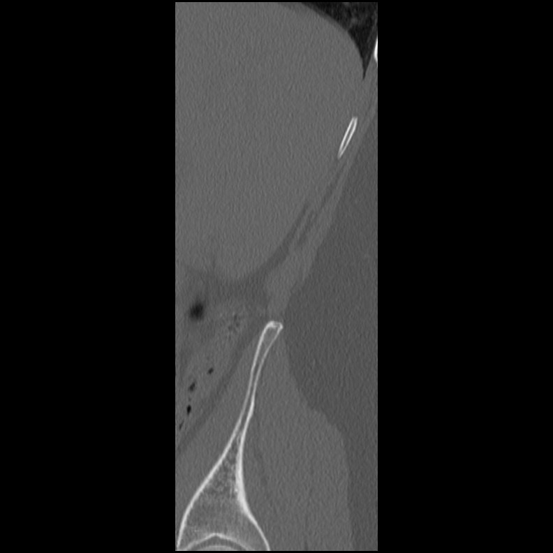 Acute Schmorl's node (Radiopaedia 83276-102365 Sagittal bone window 84).jpg
