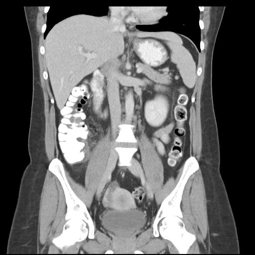 File:Acute appendicitis (Radiopaedia 30297-30934 Coronal C+ portal venous phase 24).jpg