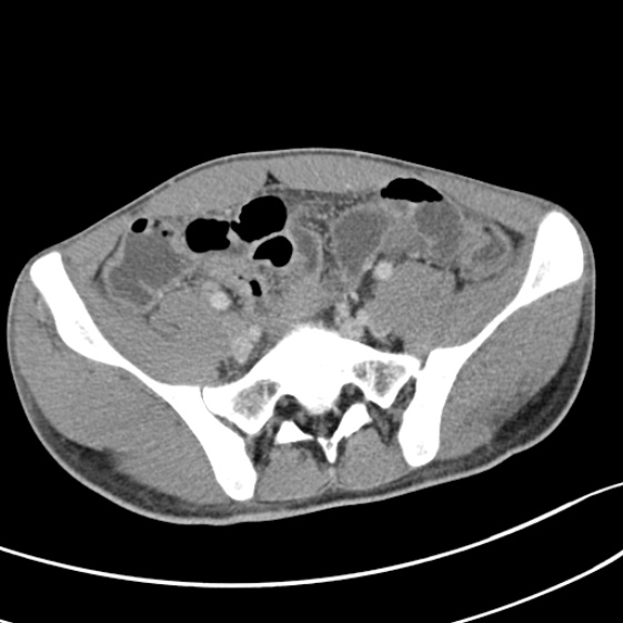 Acute appendicitis (Radiopaedia 32614-33572 Axial C+ portal venous phase 49).jpg