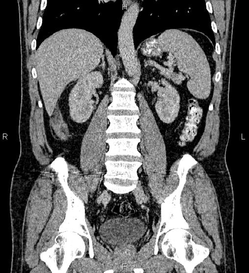 Acute appendicitis (Radiopaedia 84780-100240 Coronal C+ portal venous phase 51).jpg