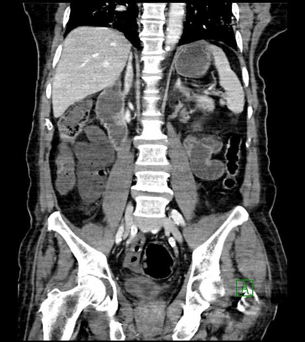 Acute arterial mesenteric ischemia (Radiopaedia 78238-90828 Coronal C+ portal venous phase 58).jpg