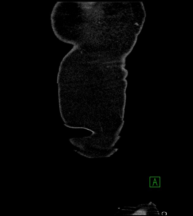 Acute arterial mesenteric ischemia (Radiopaedia 78238-90828 Coronal C+ portal venous phase 8).jpg