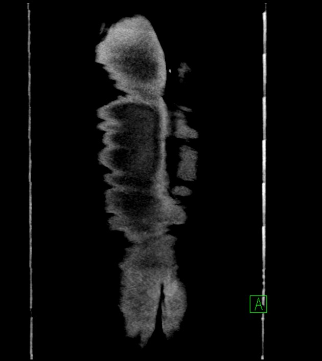 Acute arterial mesenteric ischemia (Radiopaedia 78238-90828 Coronal C+ portal venous phase 91).jpg