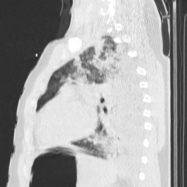 Acute aspiration pneumonitis (Radiopaedia 33605-34703 Sagittal lung window 57).jpg