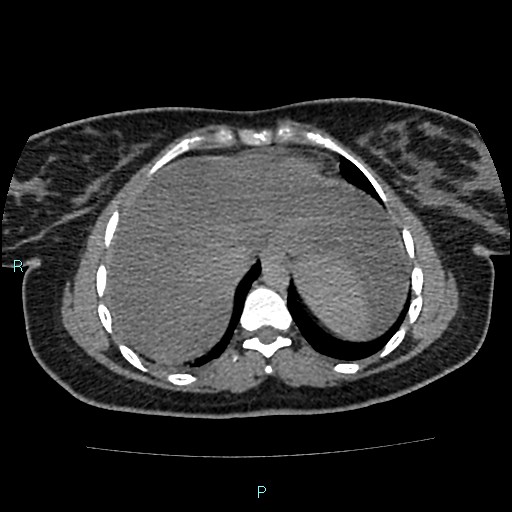 Acute bilateral pyelonephritis (Radiopaedia 37146-38881 Axial non-contrast 10).jpg