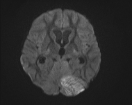 File:Acute cerebellar ataxia (Radiopaedia 61487-69446 Axial DWI 10).jpg