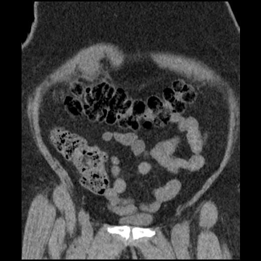 Acute cholecystitis and ureteric colic (Radiopaedia 42330-45444 Coronal prone 28).jpg