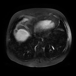Acute cholecystitis complicated by pylephlebitis (Radiopaedia 65782-74915 Axial arterioportal phase T1 C+ fat sat 1).jpg