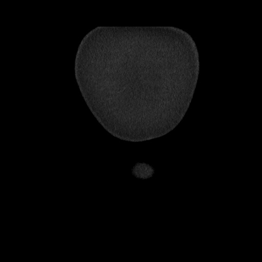 File:Acute cholecystitis with tensile fundus sign (Radiopaedia 71394-81723 Coronal non-contrast 11).jpg