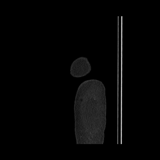 File:Acute cholecystitis with tensile fundus sign (Radiopaedia 71394-81723 Sagittal non-contrast 11).jpg