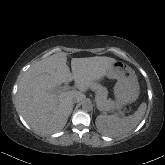 Acute colonic hemorrhage in ulcerative colitis (Radiopaedia 77415-89538 Axial non-contrast 29).jpg