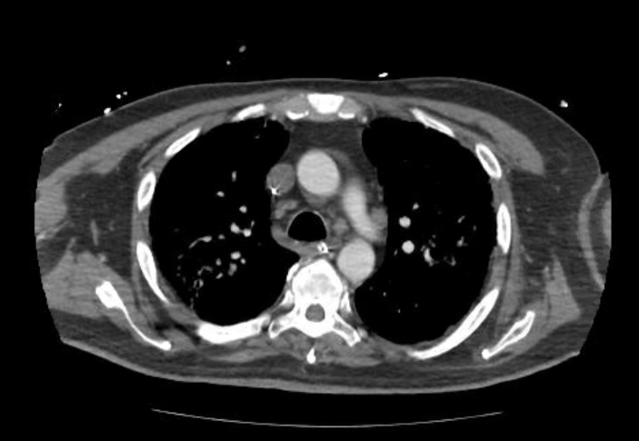 Acute cor pulmonale (ultrasound) (Radiopaedia 83508-98818 Axial C+ CTPA 24).jpg