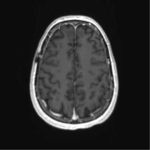 Acute disseminated encephalomyelitis (ADEM) (Radiopaedia 65319-74350 Axial T1 C+ 49).png
