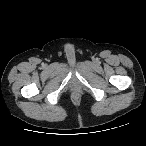 Acute diverticulitis with localized perforation (Radiopaedia 41296-44113 Axial C+ portal venous phase 97).jpg