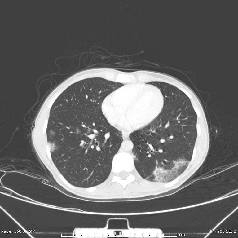 Acute eosinophilic pneumonia (Radiopaedia 48211-53073 Axial lung window 60).jpg