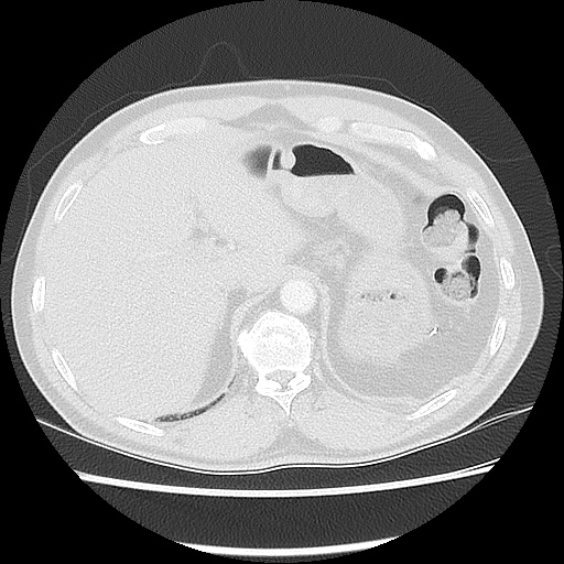 Acute epicardial fat necrosis (Radiopaedia 42327-45440 Axial lung window 52).jpg