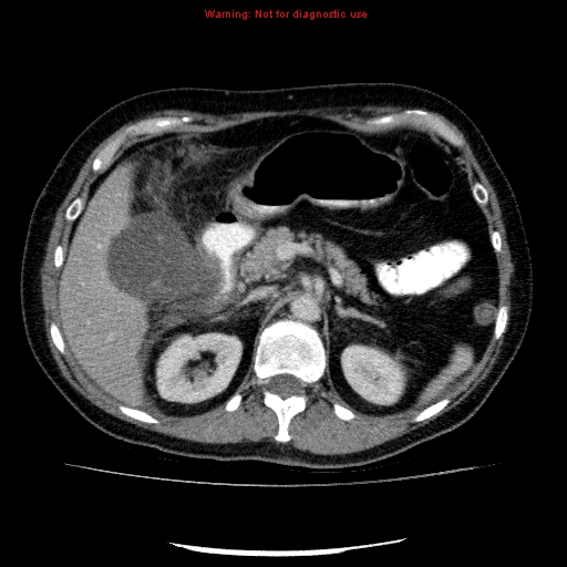 Acute gangrenous cholecystitis (Radiopaedia 10123-10661 Axial C+ portal venous phase 32).jpg