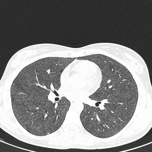 File:Acute hypersensitivity pneumonitis (Radiopaedia 85293-100870 Axial lung window 61).jpg