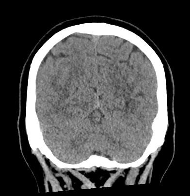 File:Acute internal carotid artery dissection (Radiopaedia 53541-59558 Coronal non-contrast 61).jpg