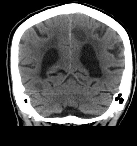 Acute left anterior cerebral artery territory infarction (Radiopaedia 51785-57578 Coronal non-contrast 44).jpg