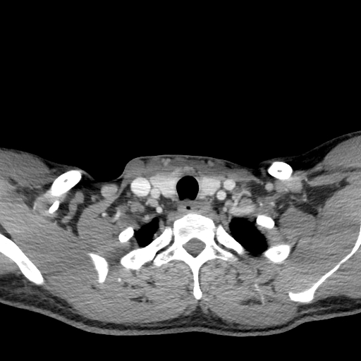 Acute longus colli calcific tendinitis (Radiopaedia 72495-83036 Axial C+ arterial phase 76).jpg