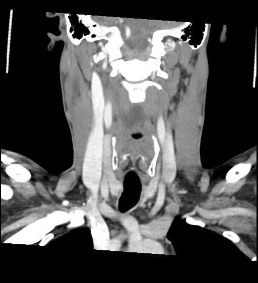 Acute longus colli calcific tendinitis (Radiopaedia 72495-83036 Coronal C+ arterial phase 35).jpg