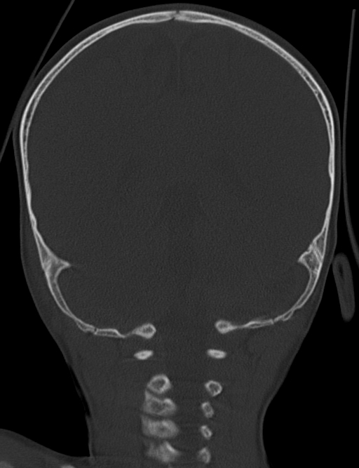 Acute mastoiditis (Radiopaedia 82678-96881 Coronal bone window 54).jpg