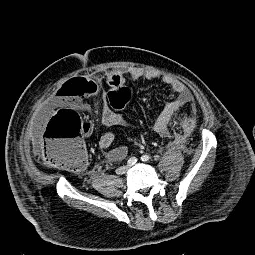 File:Acute pancreatic necrosis (Radiopaedia 13560-18501 Axial C+ portal venous phase 99).jpg