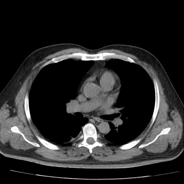 Acute pancreatitis (Radiopaedia 26663-26813 Axial non-contrast 2).jpg