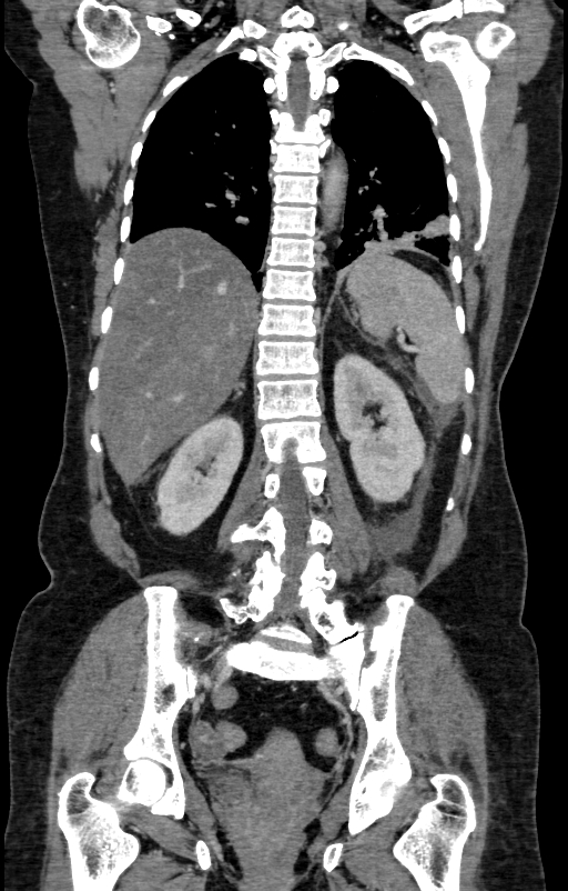 Acute pancreatitis (Radiopaedia 80007-93285 Coronal C+ portal venous phase 112).jpg