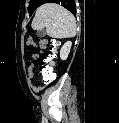 File:Acute pancreatitis (Radiopaedia 85390-101010 Sagittal C+ portal venous phase 20).jpg