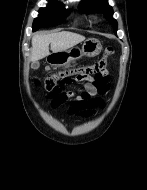 Acute pancreatitis - Balthazar E (Radiopaedia 23080-23110 Coronal C+ portal venous phase 10).jpg