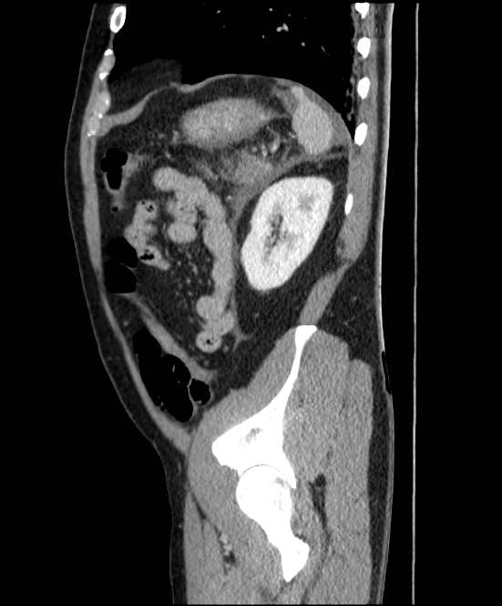 Acute pancreatitis - Balthazar E (Radiopaedia 23080-23110 Sagittal C+ portal venous phase 79).jpg