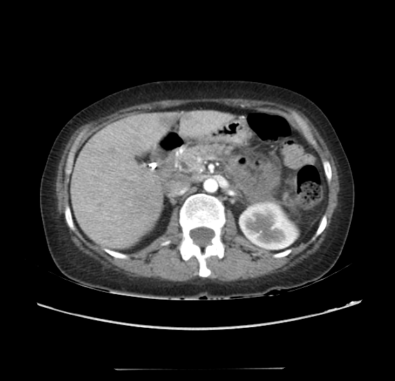 File:Acute pancreatitis - Balthazar E - post ERCP (Radiopaedia 27562-27772 Axial C+ arterial phase 19).png