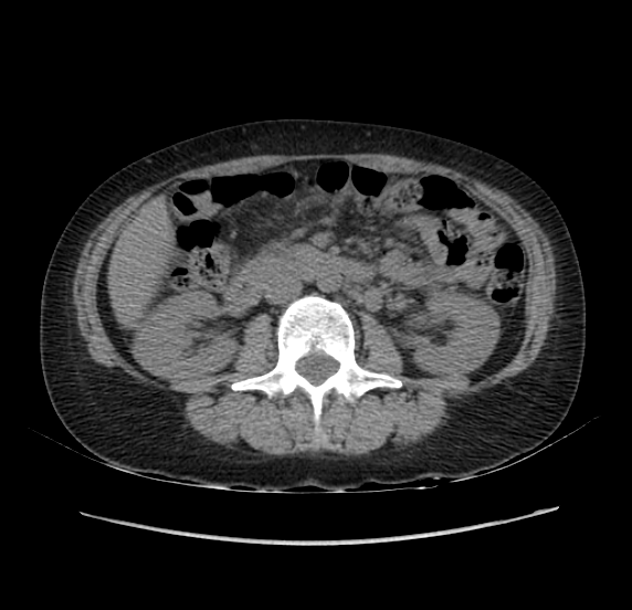 File:Acute pancreatitis - Balthazar E - post ERCP (Radiopaedia 27562-27772 Axial non-contrast 28).png