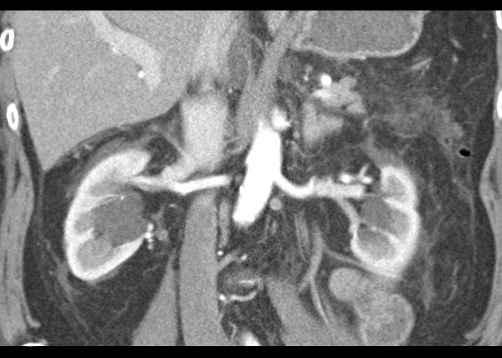 Acute pancreatitis and walled-off necrosis (Radiopaedia 29888-30403 Coronal C+ portal venous phase 33).jpg