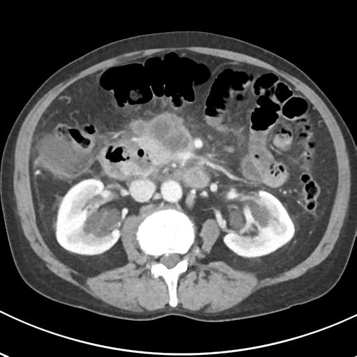 File:Acute pancreatitis and walled-off necrosis (Radiopaedia 29888-30404 Axial C+ portal venous phase 36).jpg