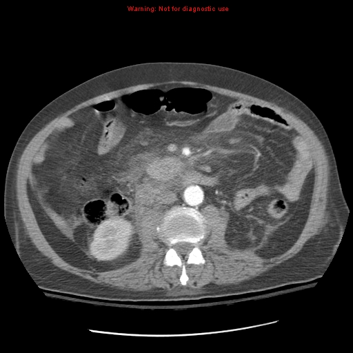 File:Acute pancreatitis with incidental pancreatic lipoma (Radiopaedia 10190-10730 Axial C+ arterial phase 54).jpg