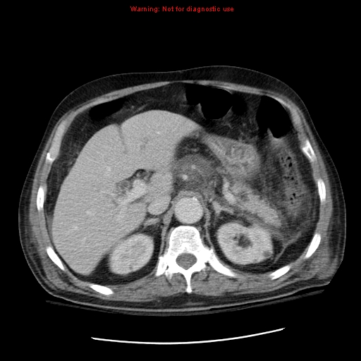 File:Acute pancreatitis with incidental pancreatic lipoma (Radiopaedia 10190-10730 Axial C+ portal venous phase 19).jpg