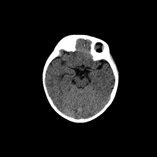 Acute phase of hemiconvulsion-hemiplegia epilepsy syndrome (Radiopaedia 29309-29744 Axial non-contrast 34).jpg