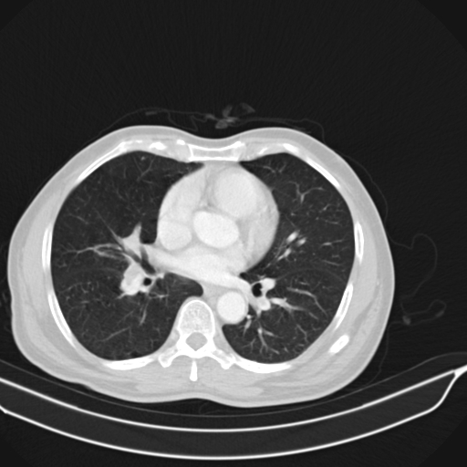 Acute pulmonary embolism (Radiopaedia 69510-79390 Axial lung window 31).jpg