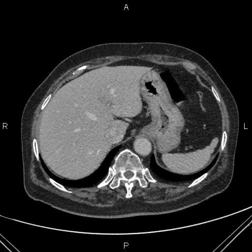 File:Acute renal artery occlusion (Radiopaedia 86586-102682 Axial C+ portal venous phase 9).jpg