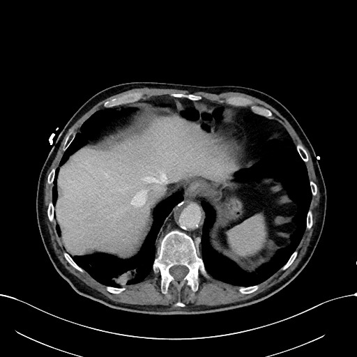 Acute renal infarction (Radiopaedia 59375-66736 Axial C+ portal venous phase 11).jpg