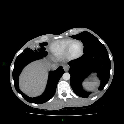 File:Acute right lung abscess (Radiopaedia 34806-36258 Axial C+ arterial phase 152).jpg