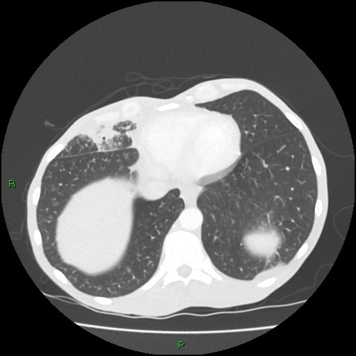 Acute right lung abscess (Radiopaedia 34806-36258 Axial lung window 150).jpg